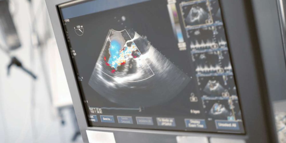 What is an echocardiogram?