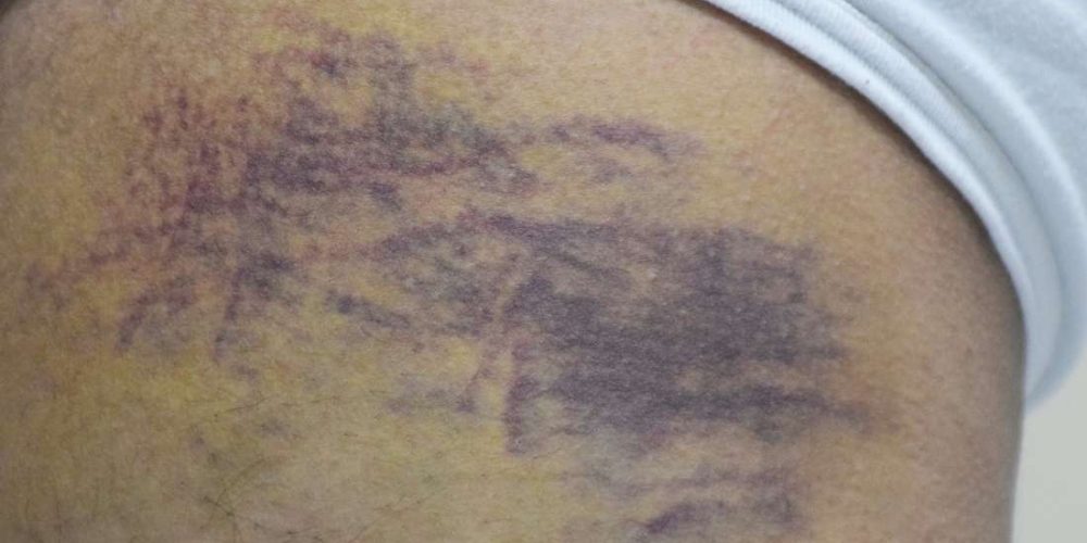 What to know about bruises on dark skin