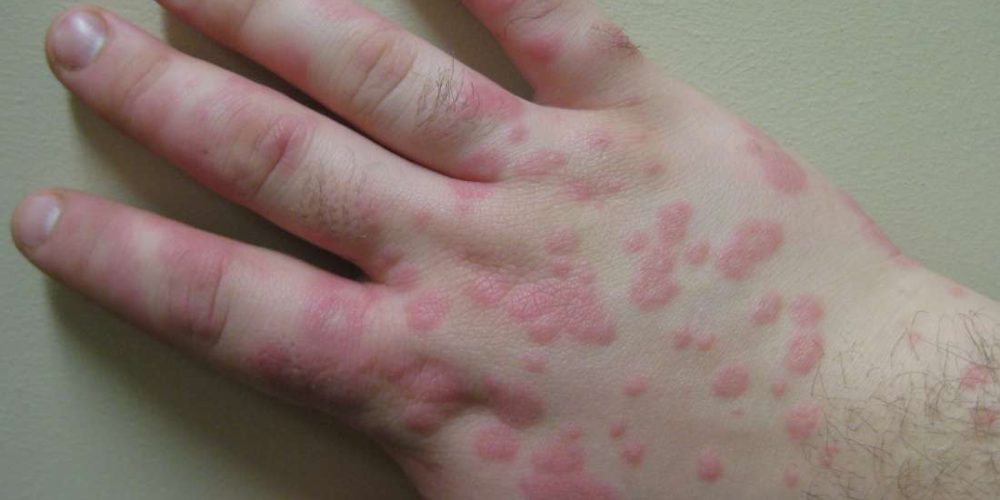 What to know about erythema multiforme
