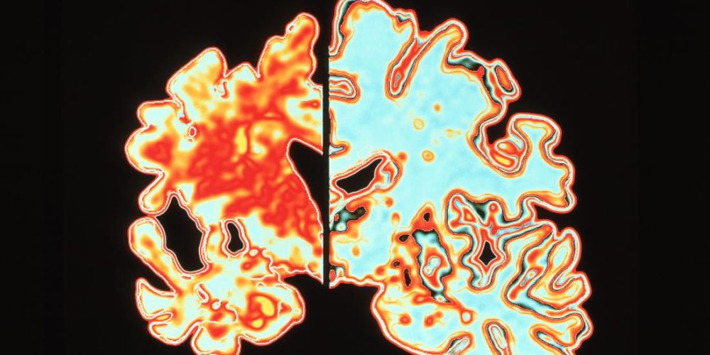 Experimental drug may prevent Alzheimer&#8217;s disease