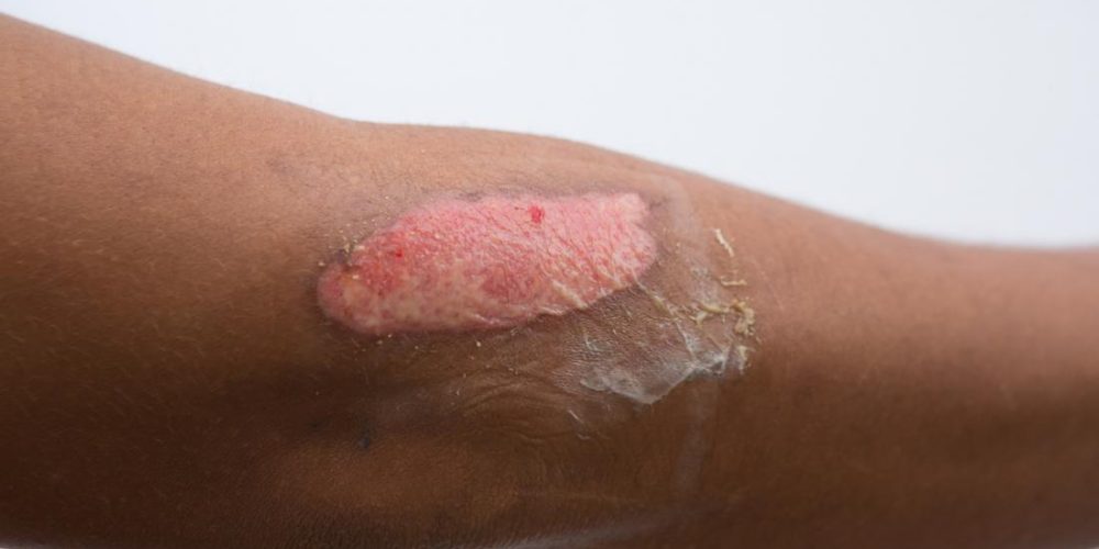 Second-degree burn: Everything you need to know
