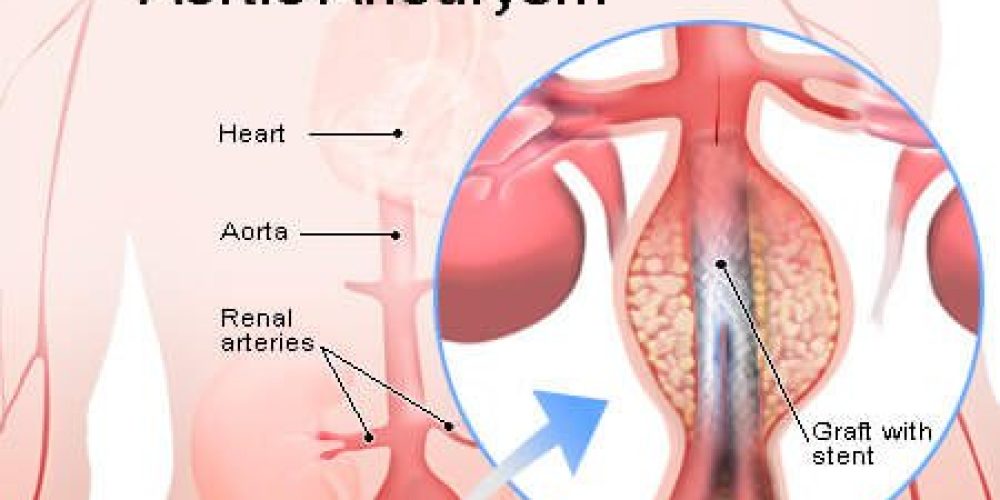 Abdominal Aortic Aneurysm (Symptoms, Repair, Surgery, Survival Rate)