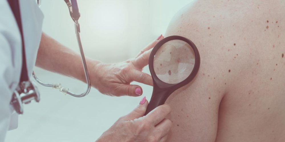 Existing antibiotic could help treat melanoma