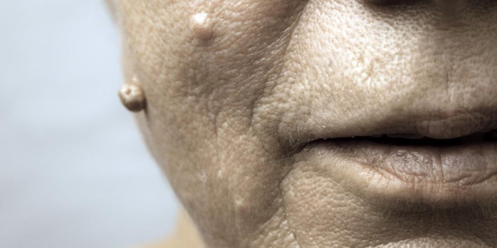 Facial warts and how to remove them