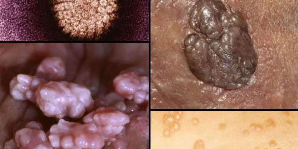 Genital Warts (HPV) Infection in Women