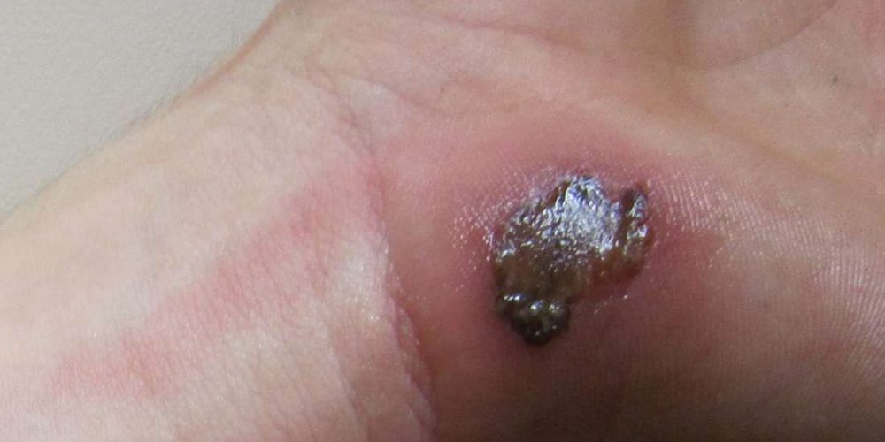 How to identify and treat infected blisters