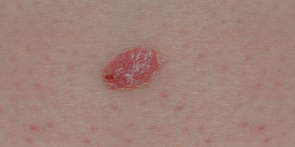 How to tell the difference between psoriasis and skin cancer