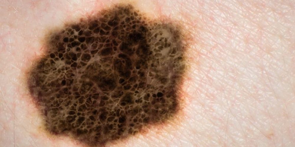 Is Melanoma Suspected? Get 2nd Opinion From Specialist, Study Says