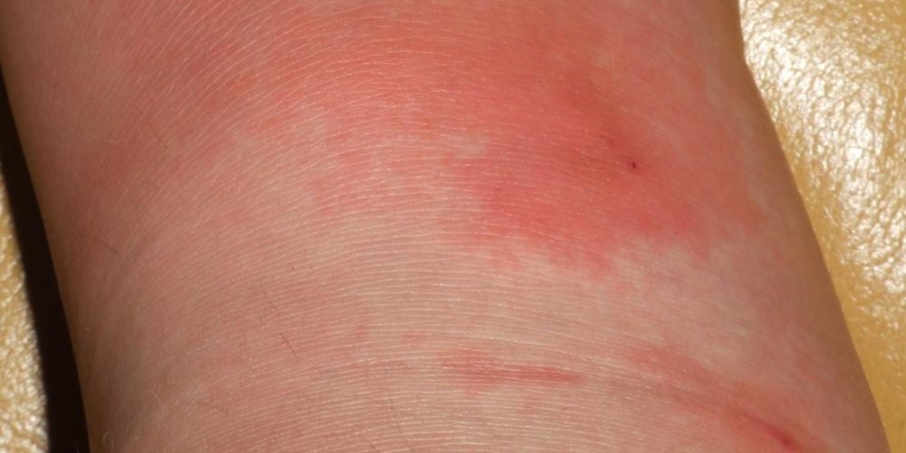What do skin infections look like?