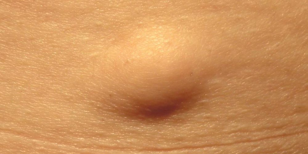 What is a lipoma?