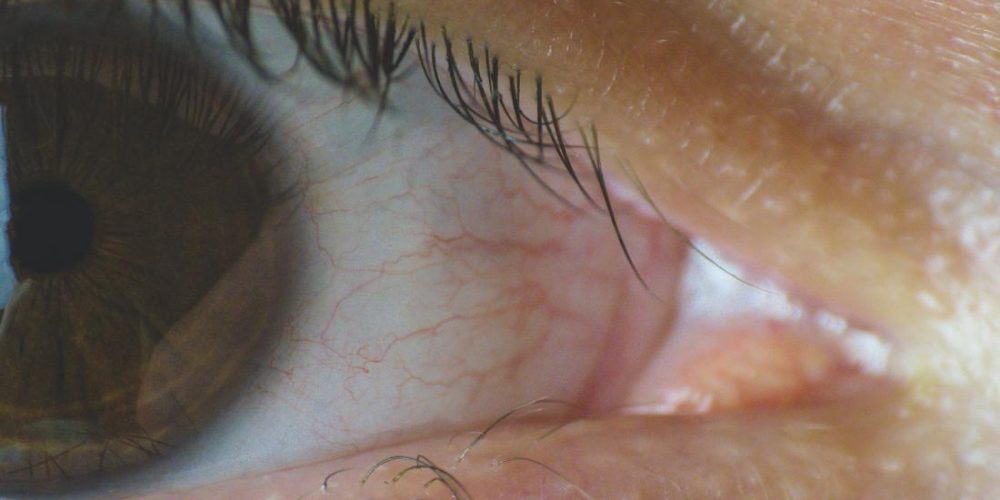 What to know about punctal plugs for dry eye