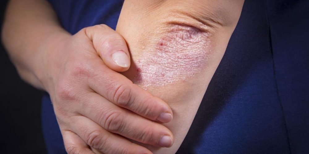 Why does psoriasis increase diabetes risk?