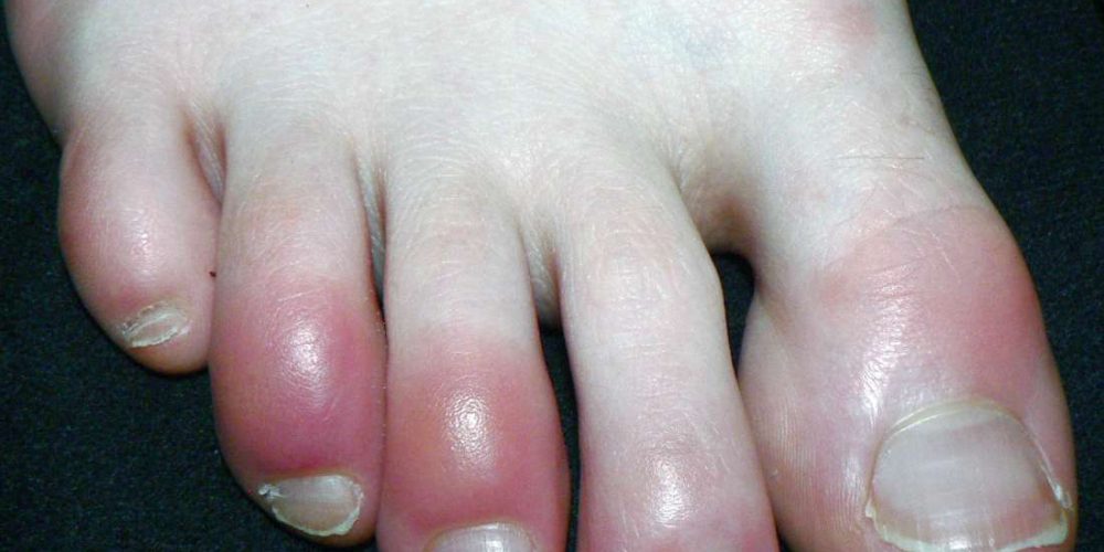 Why have my toes turned red?