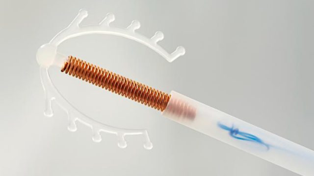 Accidental pregnancies ‘dramatically reduced’ by IUD and implant counseling