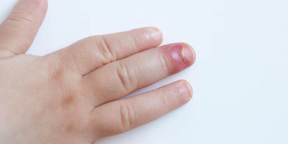 How to treat paronychia (an infected nail)