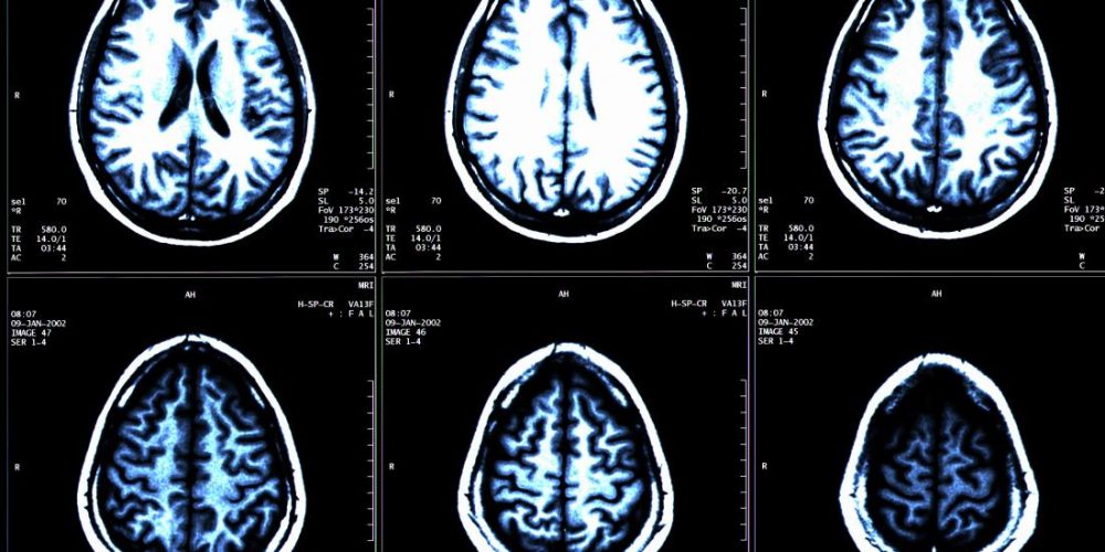 MS: New drug proven to slow brain shrinkage