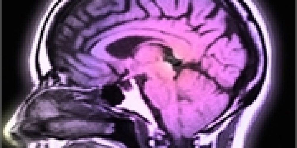 Study Might Point Alzheimer&#8217;s Research in Whole New Direction