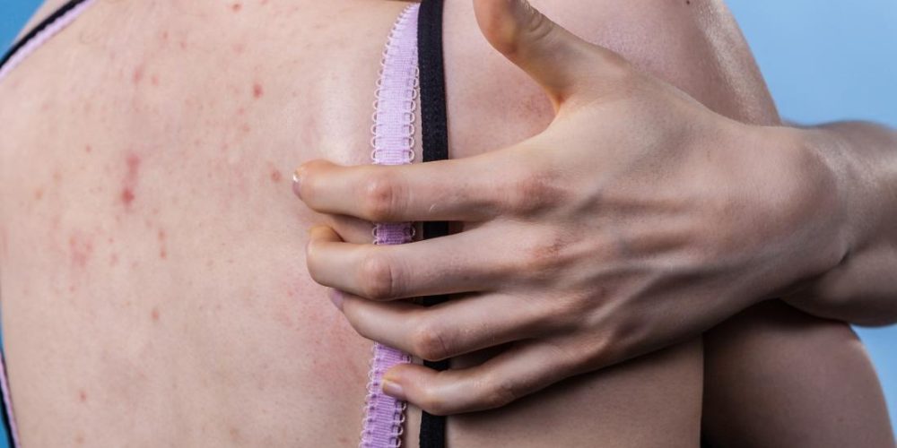What does it mean when acne is itchy?
