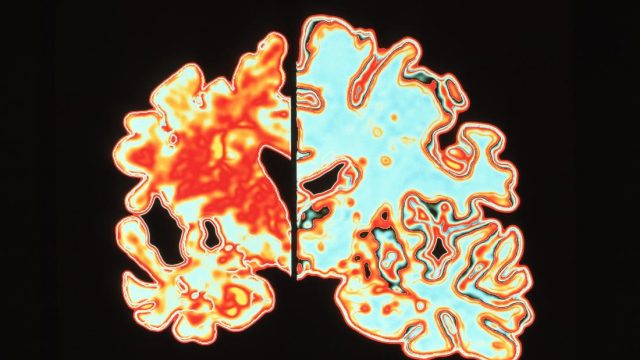 Experimental drug may prevent Alzheimer’s disease