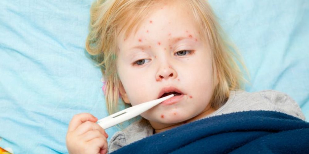 Parents, Here&#8217;s How to Protect Your Child During Measles Outbreaks