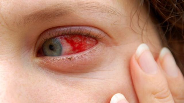Red eyes: List of common causes
